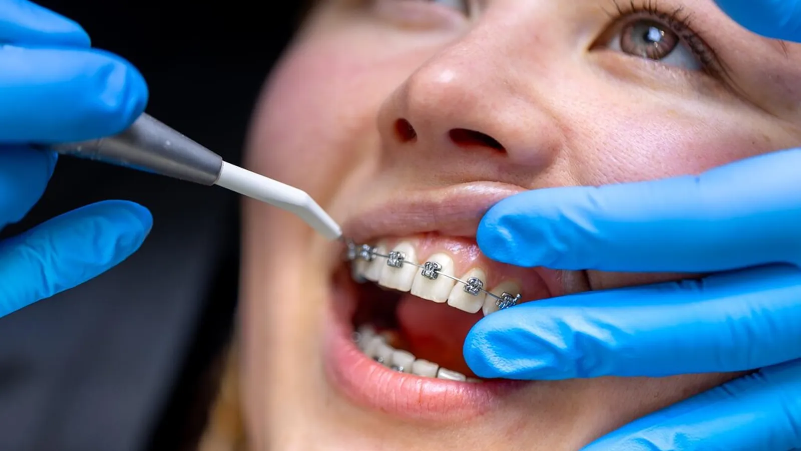 Patient in dental chair during teeth extraction consultation