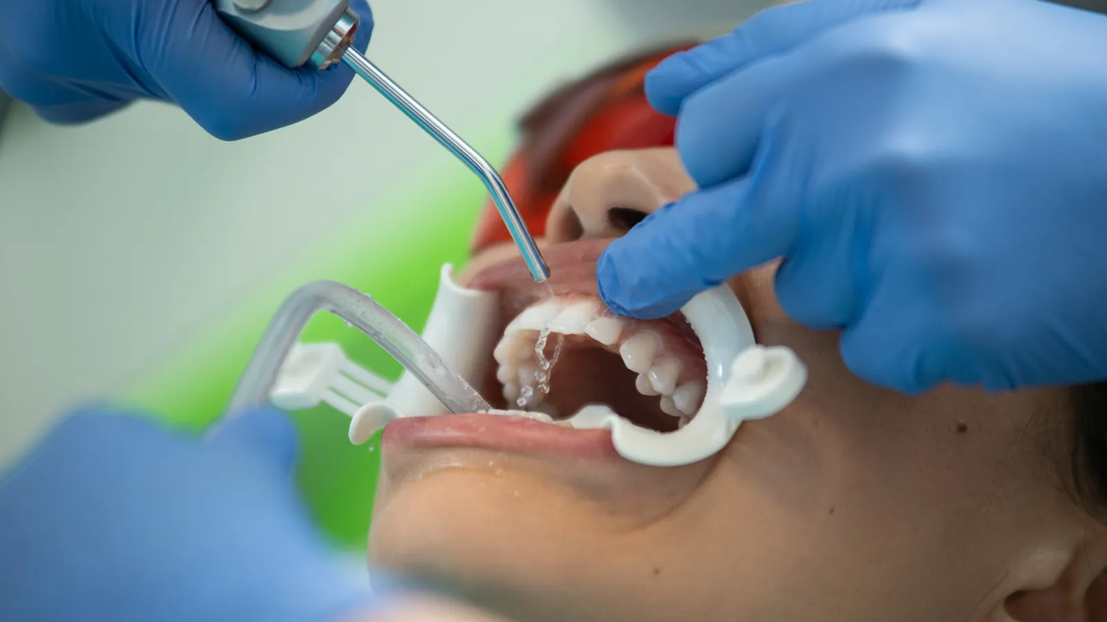 Pediatric dentist examining a child for pulpectomy treatment