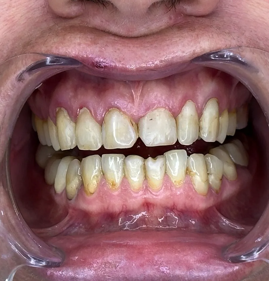 Smile transformation 6 - Before