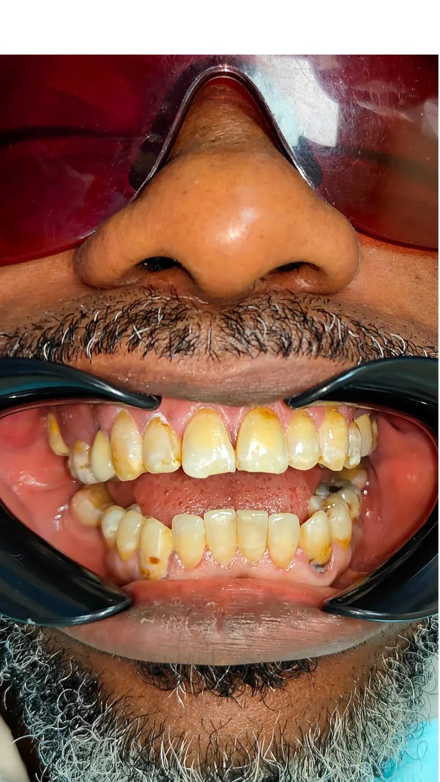 Smile transformation 8 - Before