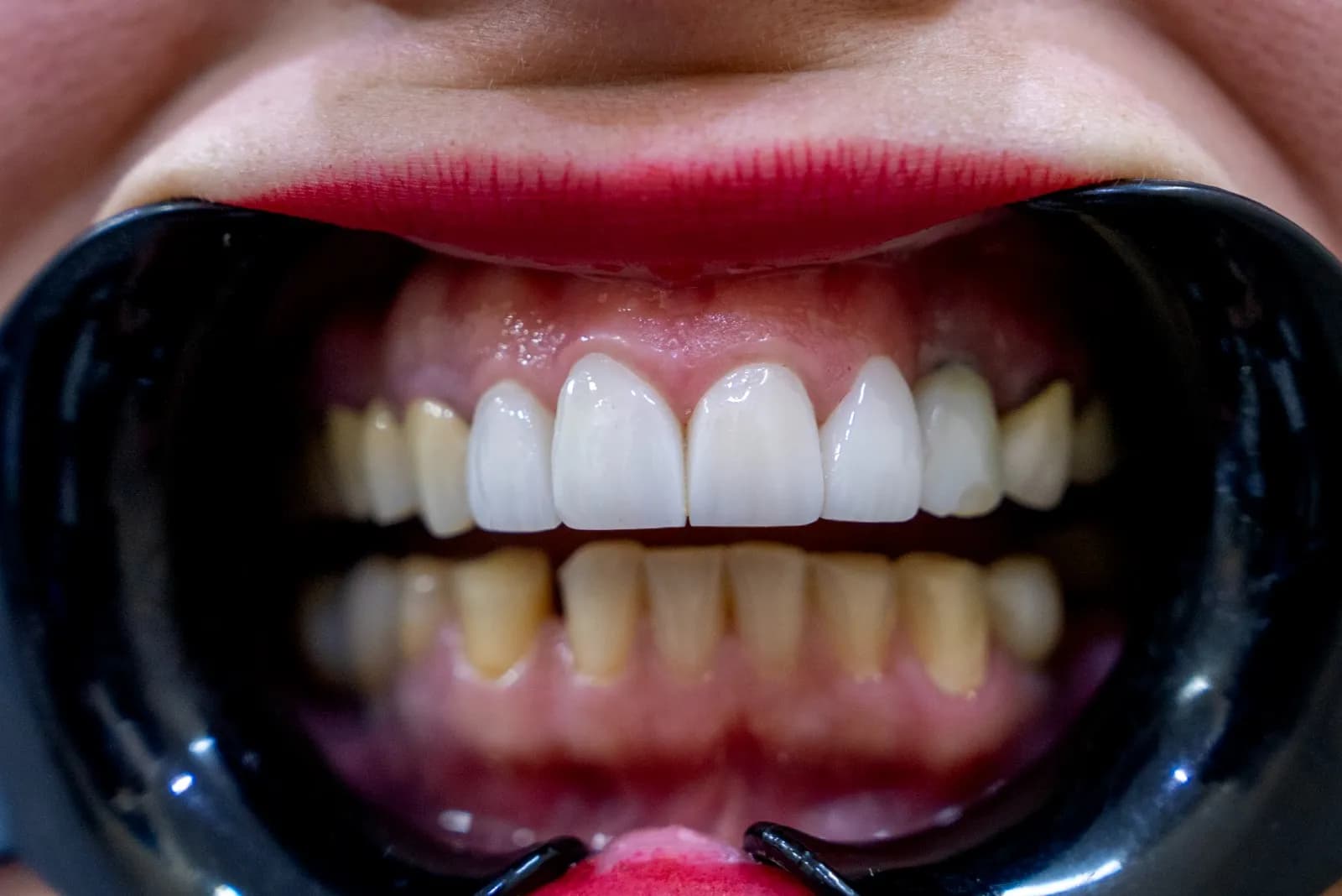 Smile transformation 4 - After