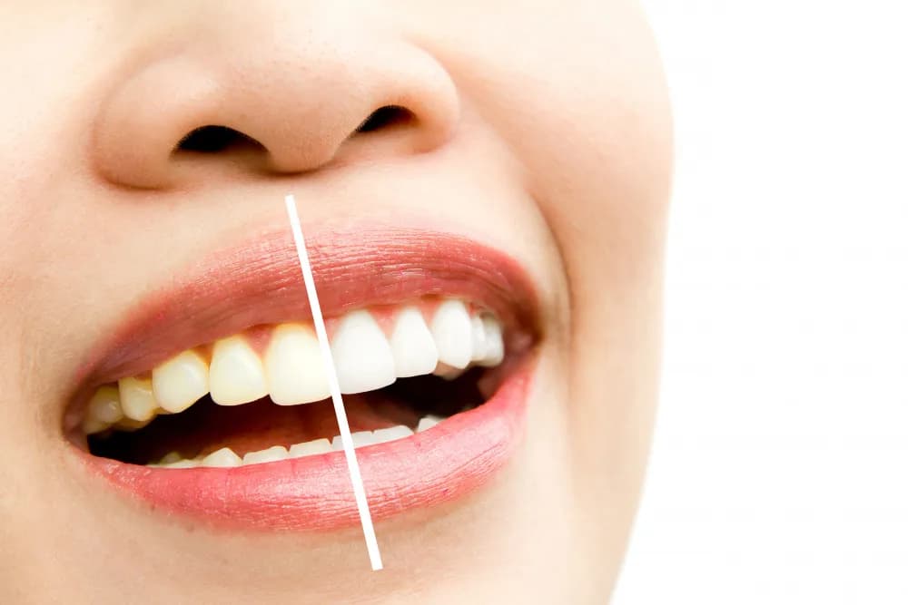 Bleached Teeth: Everything You Need to Know About Teeth Whitening